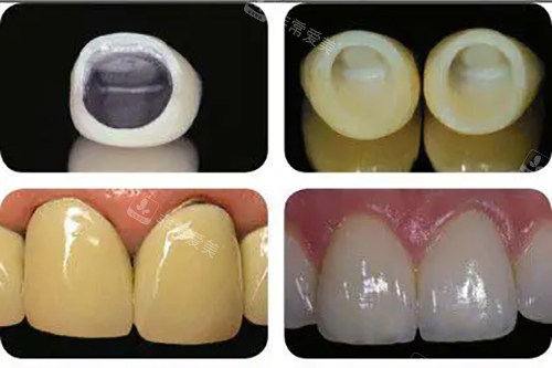 烤瓷牙冠和全瓷牙冠安装前后对比