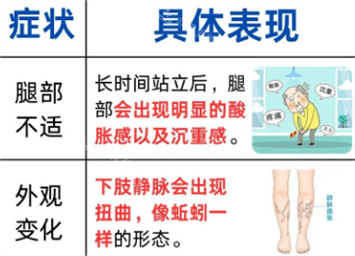 静脉曲张表现 静脉曲张表现