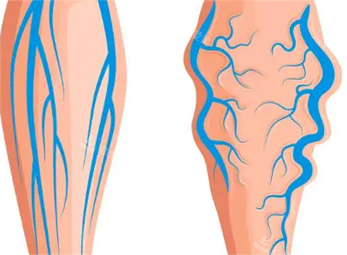 静脉曲张的变化 静脉曲张的变化