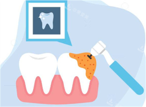 牙钻治疗牙齿图