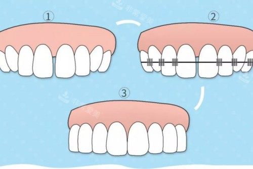 牙齿矫正步骤图