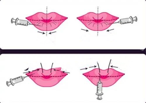 玻尿酸丰唇前后对比图