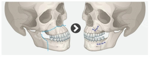 双颚手术的前后对比 双颚手术的前后对比