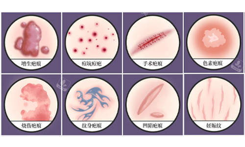 岳阳疤痕修复手术哪家好？你好美整形专科专治分层修复技术疤痕淡化90%+口碑特别好