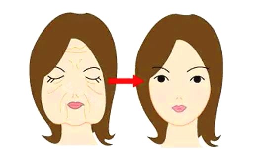 拉皮对比图 拉皮对比图