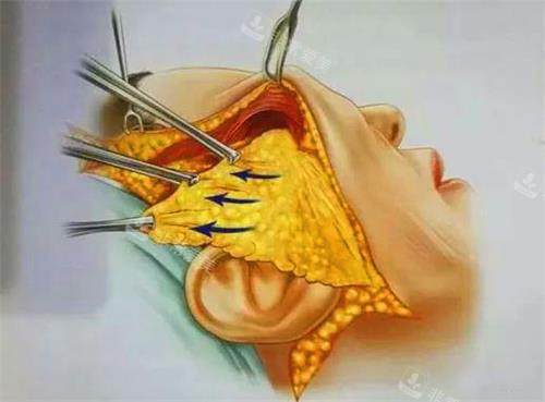 拉皮手术示意图.jpg 拉皮手术示意图.jpg