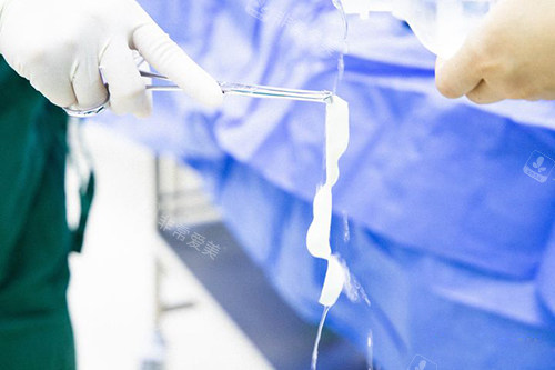 3d生物束带紧缩术实物图