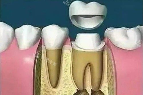 根管治疗戴牙冠卡通图