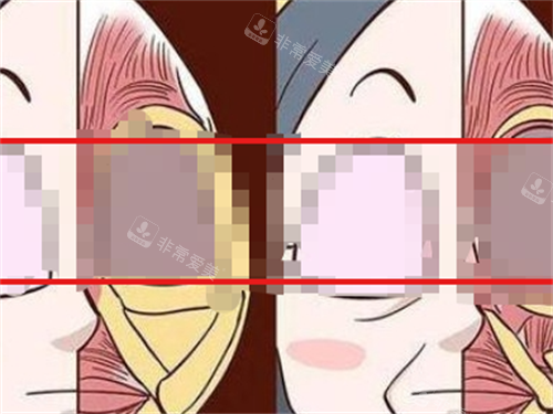 玻尿酸栓塞组织对比动画