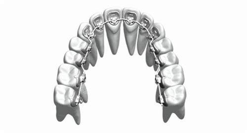 牙齿矫正舌侧矫正牙套概念透视图