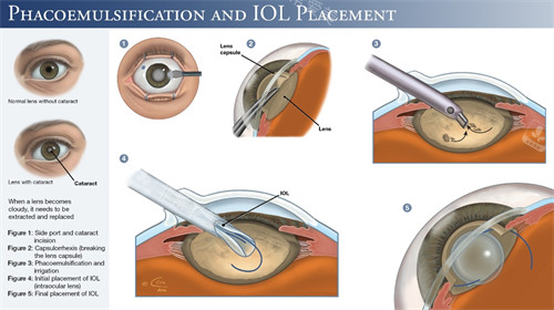 超声乳化白内障手术细节图