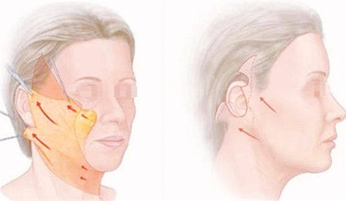 拉皮手术前后成果对比展示图