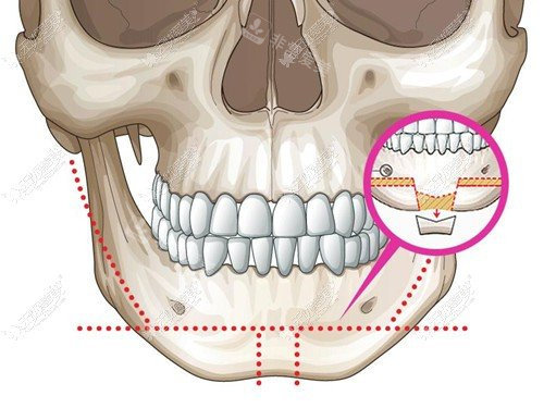T型截骨术手术切口演示动画图 T型截骨术手术切口演示动画图