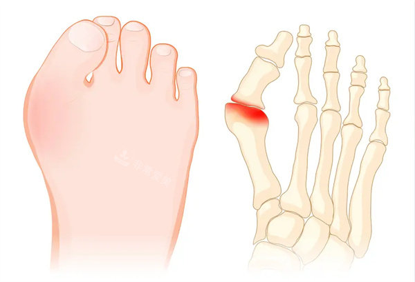 大脚骨矫正术 大脚骨矫正术