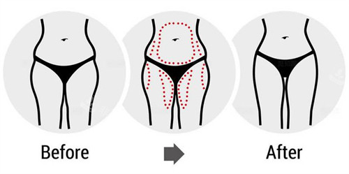 腰腹大腿吸脂前后对比图 腰腹大腿吸脂前后对比图