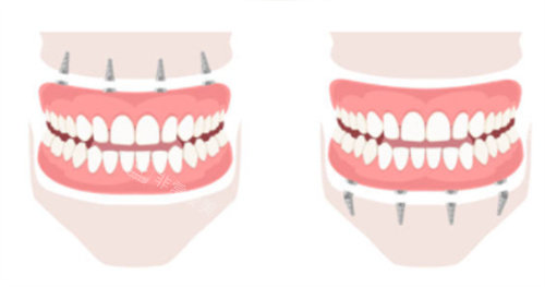 上半口种植牙和下半口种植牙