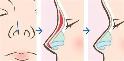 隆鼻手术过程 隆鼻手术过程
