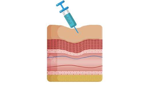Juvelook素颜针注射示意图