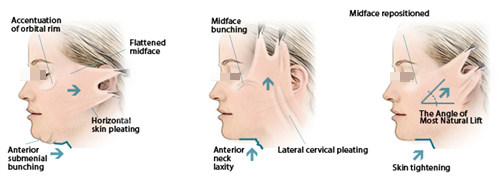 面部提升三种提升方向 面部提升三种提升方向