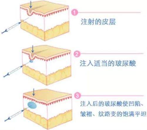玻尿酸注射示意图
