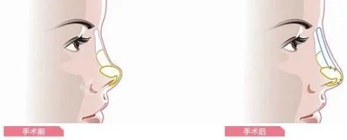 隆鼻前后对比图 隆鼻前后对比图