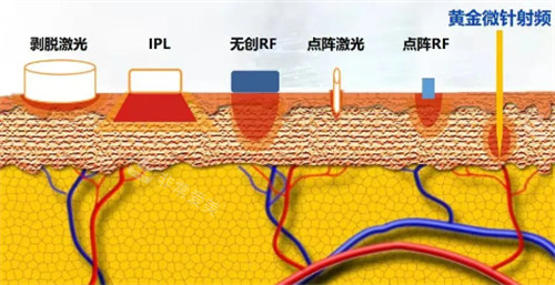 黄金微针射频层次 黄金微针射频层次