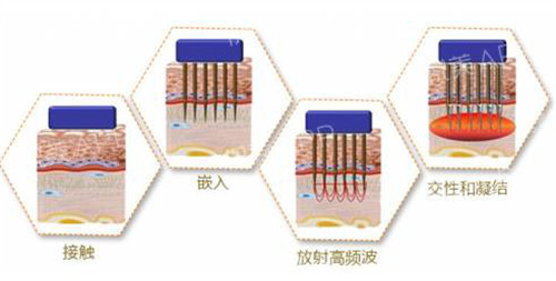 黄金微针原理解析 黄金微针原理解析