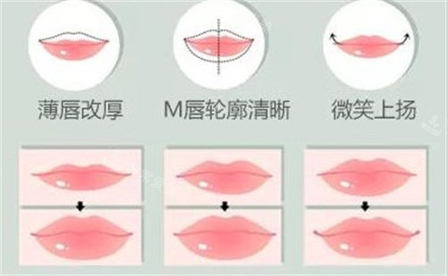 嘴唇整形手术 嘴唇整形手术