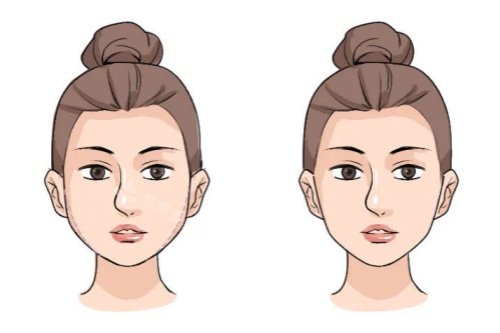 面部馒化修复卡通对比图