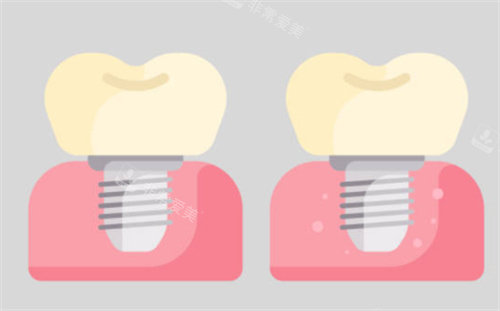 种植牙对比图