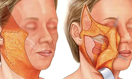 拉皮手术过程动画示意图 拉皮手术过程动画示意图