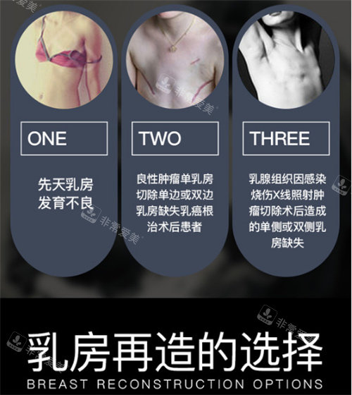 乳房再造适应症
