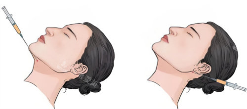 双下巴注射 双下巴注射