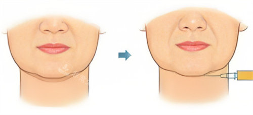 双下巴注射示图 双下巴注射示图
