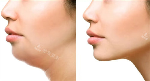 双下巴吸脂 双下巴吸脂