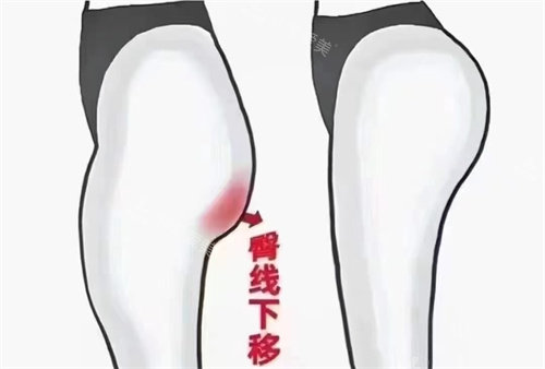 臀部脂肪填充对比