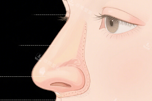 隆鼻示意图 隆鼻示意图