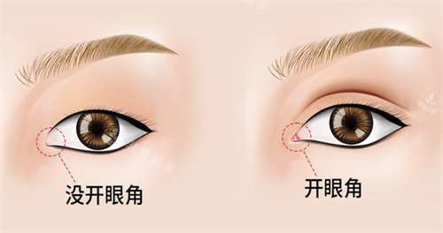 开眼角手术对比 开眼角手术对比