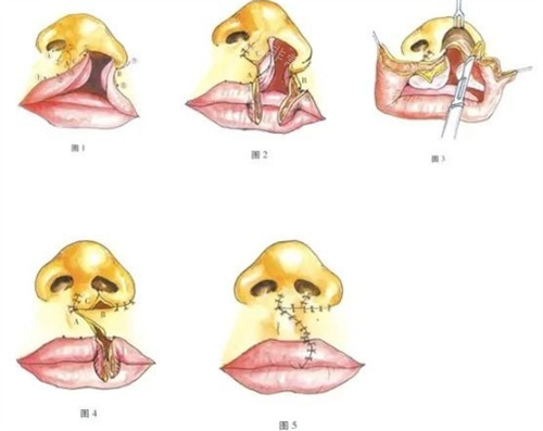 兔唇修复手术过程图解 兔唇修复手术过程图解