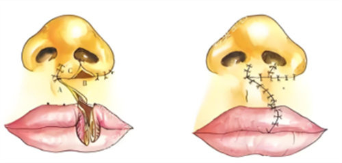 单侧鼻畸形兔唇术 单侧鼻畸形兔唇术