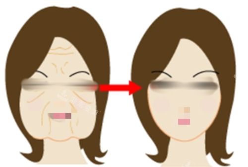 拉皮前后明显对比图 拉皮前后明显对比图