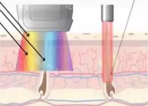 激光祛疤作用光波示意图 激光祛疤作用光波示意图