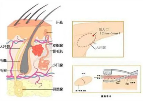 腋臭手术切口位置图解 腋臭手术切口位置图解
