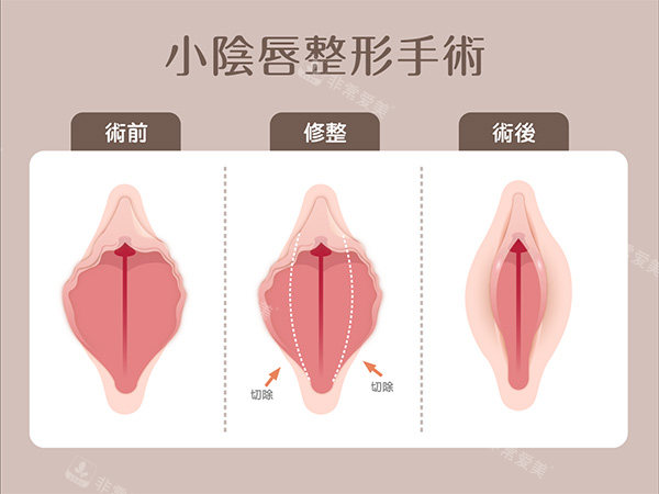 小阴唇整形手术 小阴唇整形手术