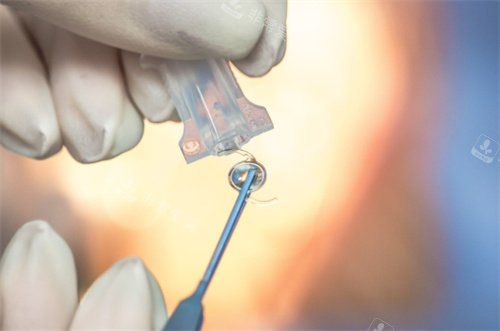 强生ICB00晶体取出