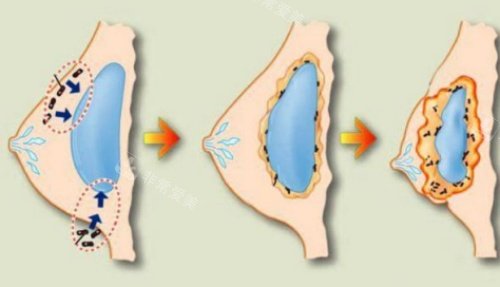 丰胸薄膜挛缩形成示意图 丰胸薄膜挛缩形成示意图