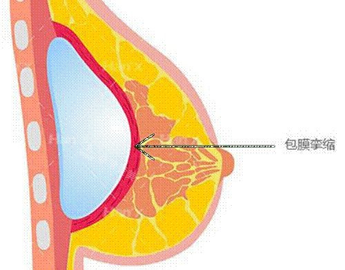 假体丰胸薄膜挛缩示意图 假体丰胸薄膜挛缩示意图