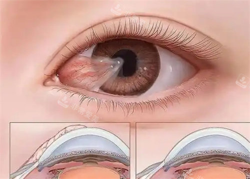 眼球结膜松弛卡通图