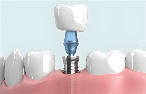 种植牙模型结构图片