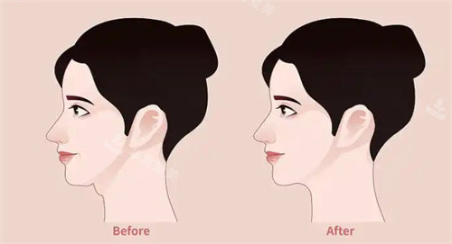 韩国做双下巴真的靠谱吗？吸脂去脂不留痕，自然紧致不反弹，体验过都夸好！